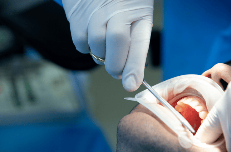 Tooth Restoration